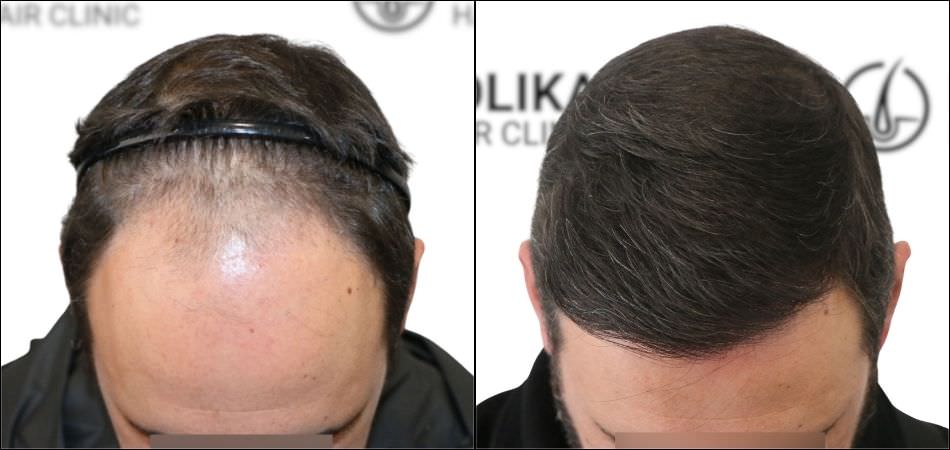 Antes Después de Trasplante Capilar en Madrid de 2700 Injertos - Clínica Capilar Folika Hair Clinic