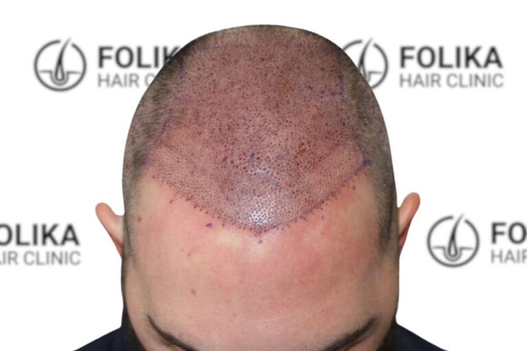 Injerto Capilar en Madrid para recuperar el pelo - 3000 Injertos - Clínica Capilar en Camberí - Folika Hair Clinic 8