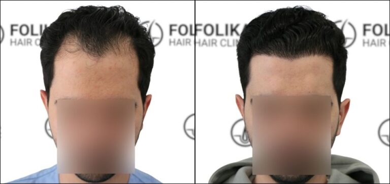 Injerto Capilar en Madrid para recuperar el pelo - Foto Antes Después de 2700 Injertos - Clínica Capilar en Camberí - Folika Hair Clinic