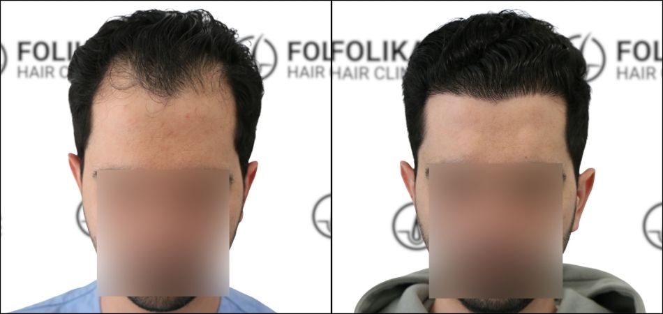Injerto Capilar en Madrid para recuperar el pelo - Foto Antes Después de 2700 Injertos - Clínica Capilar en Camberí - Folika Hair Clinic