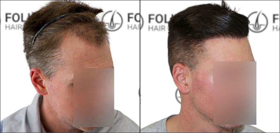 Injerto Capilar en Madrid para recuperar el pelo - Foto Antes y Despues de 1500 Injertos - Clínica Capilar en Camberí - Folika Hair Clinic