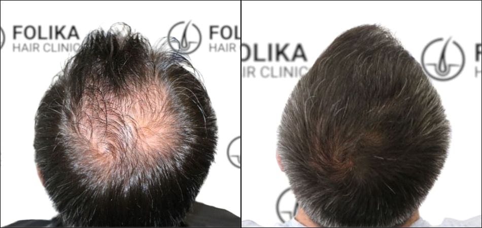 Injerto-Capilar-en-Madrid-para-recuperar-el-pelo-Foto-Antes-y-Despues-de-1800-Injertos-en-coronilla-Clinica-Capilar-en-Camberi-Folika-Hair-Clinic