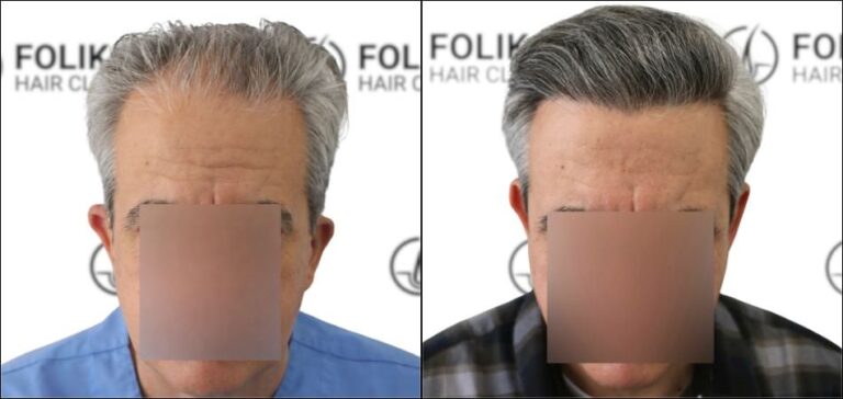 Injerto Capilar en Madrid para recuperar el pelo - Foto Antes y Despues de 2400 Injertos en frontal - Clínica Capilar en Camberí - Folika Hair Clinic