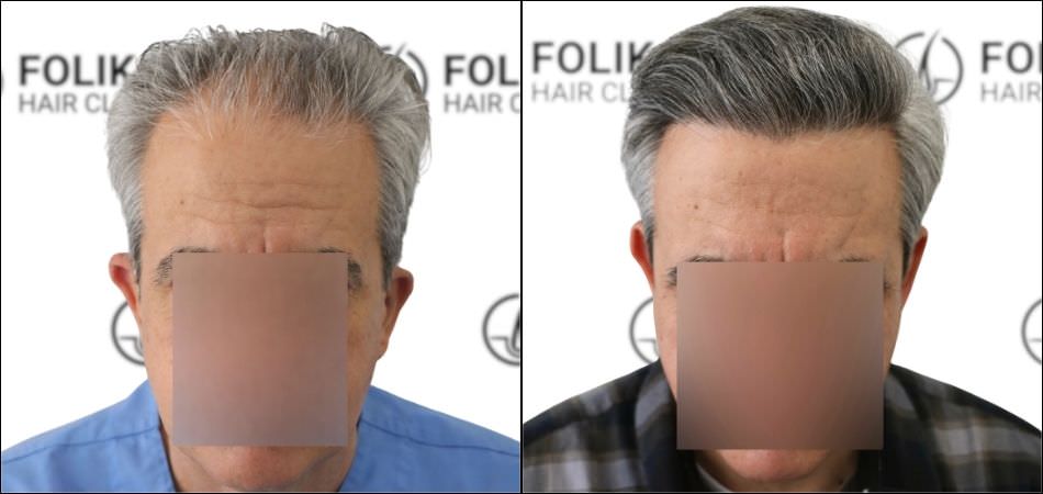 Injerto Capilar en Madrid para recuperar el pelo - Foto Antes y Despues de 2400 Injertos en frontal - Clínica Capilar en Camberí - Folika Hair Clinic