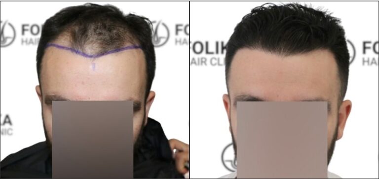 Injerto Capilar en Madrid para recuperar el pelo - Foto Antes y Despues de 2500 Injertos - Clínica Capilar en Camberí - Folika Hair Clinic