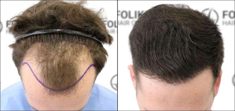 Injerto Capilar en Madrid para recuperar el pelo - Foto Antes y Despues de 2500 Injertos en frontal - Clínica Capilar en Camberí - Folika Hair Clinic