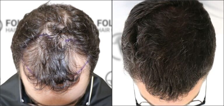 Injerto Capilar en Madrid para recuperar el pelo - Foto Antes y Despues de 2500 Injertos en frontal - Clínica Capilar en Camberí - Folika Hair Clinic