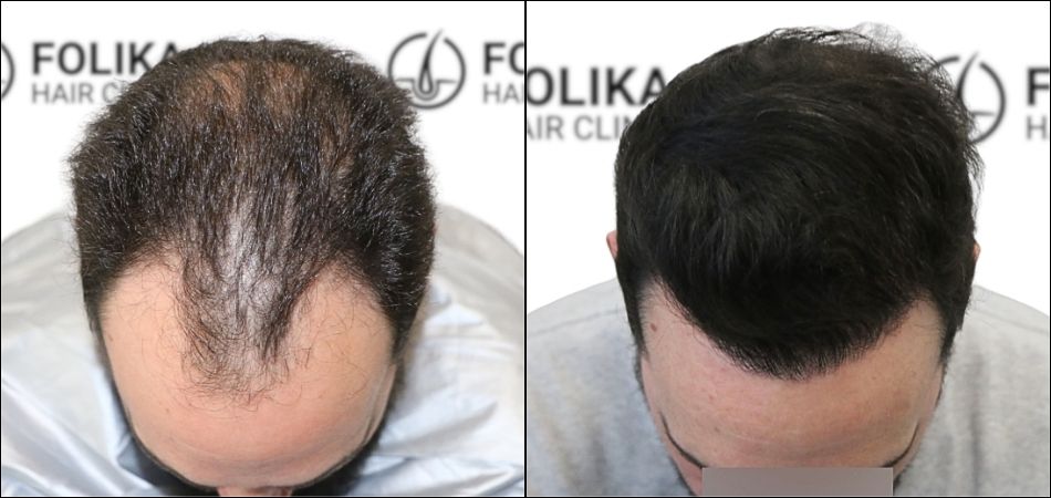 Injerto Capilar en Madrid para recuperar el pelo - Foto Antes y Despues de 3000 Injertos - Clínica Capilar en Camberí - Folika Hair Clinic