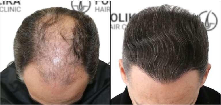 Injerto Capilar en Madrid para recuperar el pelo - Foto Antes y Después de 3284 Injertos - Clínica Capilar en Camberí - Folika Hair Clinic