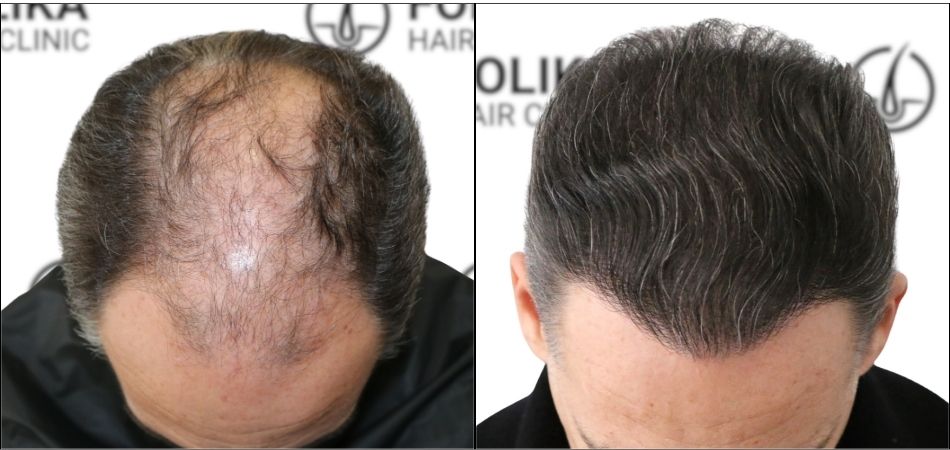 Injerto Capilar en Madrid para recuperar el pelo - Foto Antes y Después de 3284 Injertos - Clínica Capilar en Camberí - Folika Hair Clinic