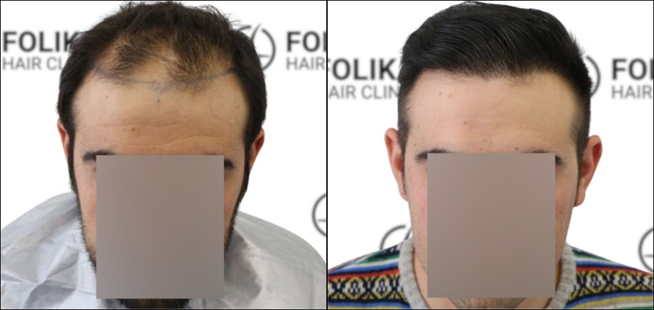 Injerto-Capilar-en-Madrid-para-recuperar-el-pelo-Foto-Antes-y-Despues-de-3500-Injertos-Clinica-Capilar-en-Camberi-Folika-Hair-Clinic
