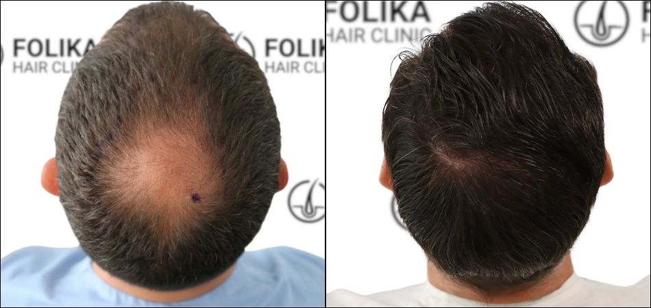Injerto Capilar en Madrid para recuperar el pelo en coronilla - Foto Antes y Despues de 1500 Injertos - Clínica Capilar en Camberí - Folika Hair Clinic