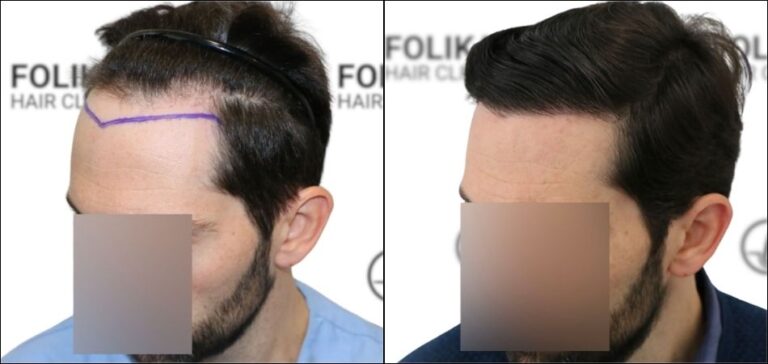 Antes Despues Injerto Capilar en Madrid para recuperar el pelo - Foto Antes y Despues de 1700 Injertos para Frontal - Clínica Capilar en Camberí - Folika Hair Clinic