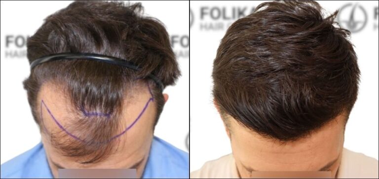 Antes Despues Injerto Capilar en Madrid para recuperar el pelo - Foto Antes y Despues de 1700 Injertos para Frontal - Clínica Capilar en Camberí - Folika Hair Clinic