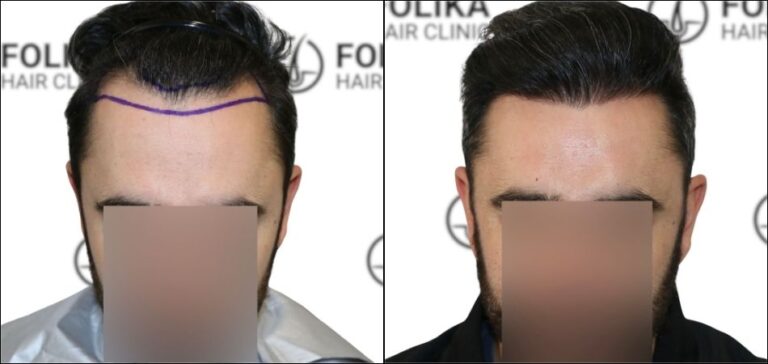 Antes Despues Injerto Capilar en Madrid para recuperar el pelo - Foto Antes y Despues de 1750 Injertos para Frontal - Clínica Capilar en Camberí - Folika Hair Clinic