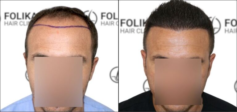 Antes Despues Injerto Capilar en Madrid para recuperar el pelo - Foto Antes y Despues de 3000 Injertos para Frontal - Clínica Capilar en Camberí - Folika Hair Clinic