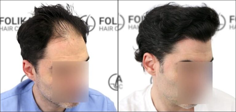 Injerto Capilar en Madrid para recuperar el pelo - Foto Antes y Despues de 2700 Injertos en frontal - Clínica Capilar en Camberí - Folika Hair Clinic