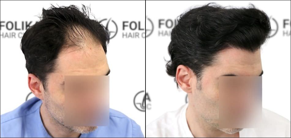 Injerto Capilar en Madrid para recuperar el pelo - Foto Antes y Despues de 2700 Injertos en frontal - Clínica Capilar en Camberí - Folika Hair Clinic