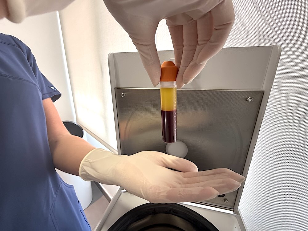 Primer plano de las manos de una enfermera con guantes sosteniendo un tubo con Plasma Rico en Plaquetas (PRP) recién centrifugado, mostrando la separación del plasma listo para el tratamiento capilar en Folika Hair Clinic.