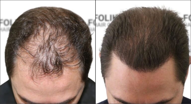 Reparación Injerto Capilar Fallido - Reparación en Madrid, Clínica Capilar Folika Hair Clinic