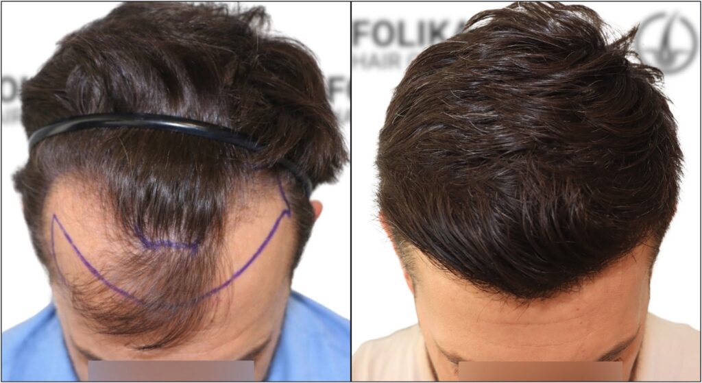 Resultado-Injerto-Capilar-en-Madrid-de-1700-Grafts-Folika-Hair-Clinic