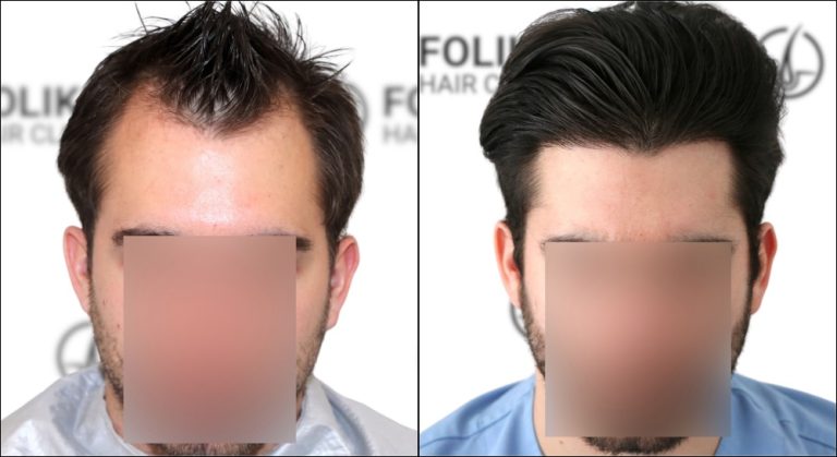 Antes-despues-injerto-capilar-en-Madrid-1800-Injertos-FUE-en-Folika-Hair-Clinic