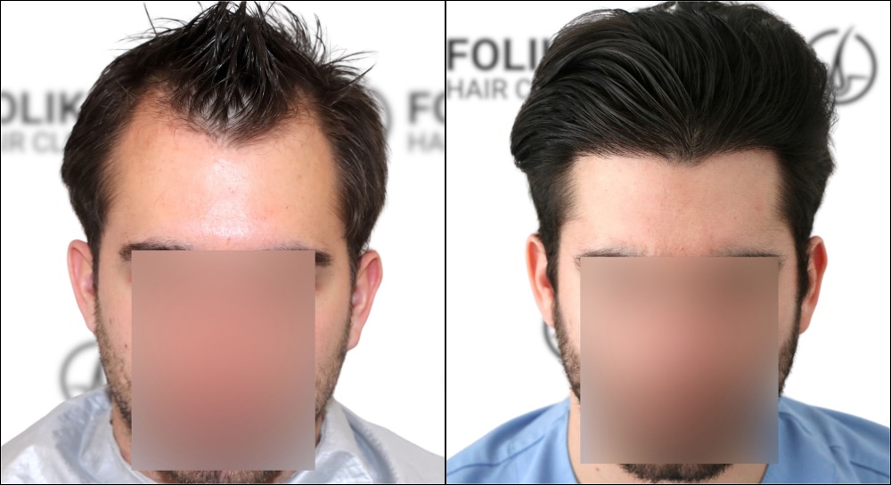 Antes-despues-injerto-capilar-en-Madrid-1800-Injertos-FUE-en-Folika-Hair-Clinic