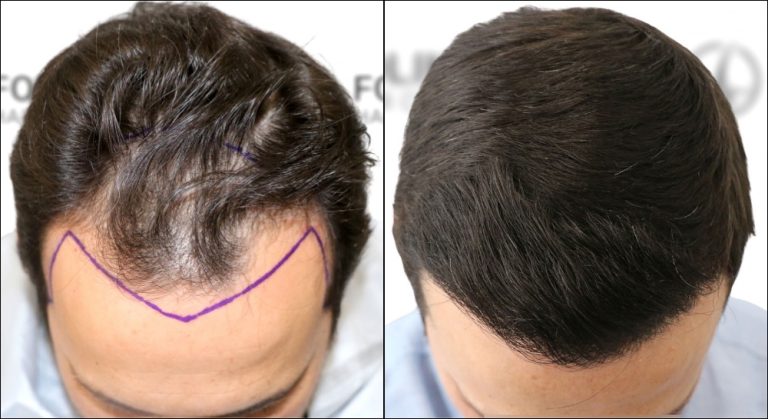 Antes-despues-Injerto-Capilar-en-Madrid-para-recuperar-el-pelo-2400-Injertos-Clinica-Capilar-en-Camberi-Folika-Hair-Clinic.