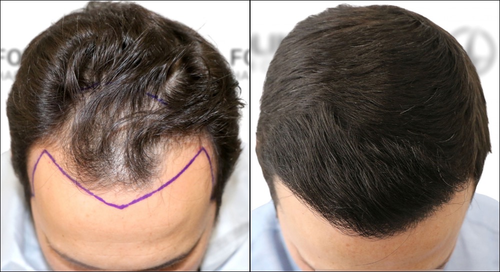 Antes-despues-Injerto-Capilar-en-Madrid-para-recuperar-el-pelo-2400-Injertos-Clinica-Capilar-en-Camberi-Folika-Hair-Clinic.